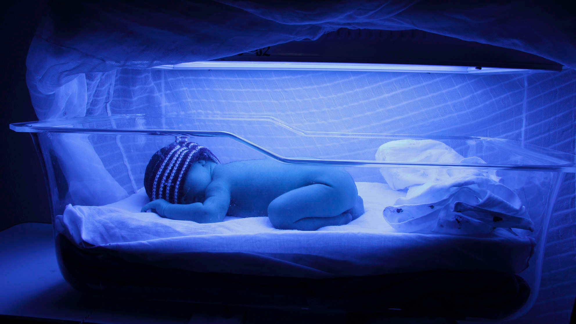 19 Facts About Jaundice And How To Deal With It